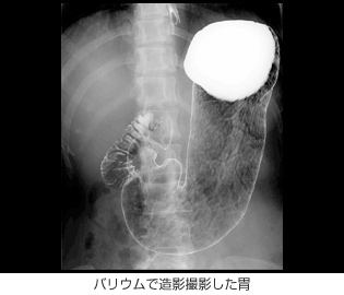 バリウムで造影撮影した胃 バリウムで造影撮影した胃