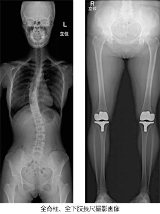 全脊柱、全下肢長尺撮影画像 全脊柱、全下肢長尺撮影画像